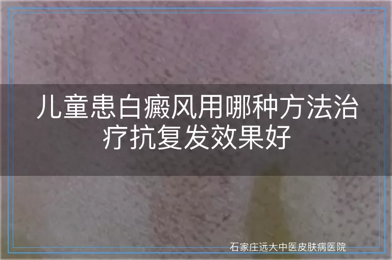 儿童患白癜风用哪种方法治疗抗复发效果好