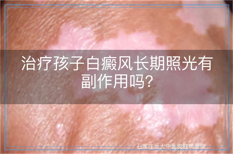 治疗孩子白癜风长期照光有副作用吗?