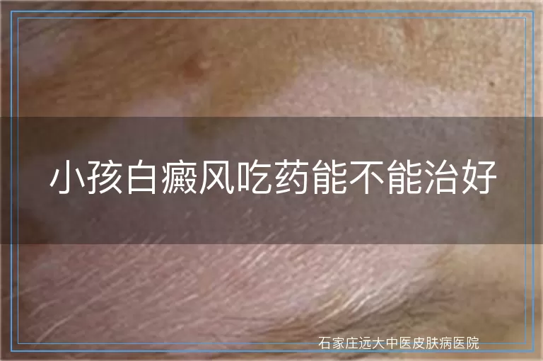 小孩白癜风吃药能不能治好