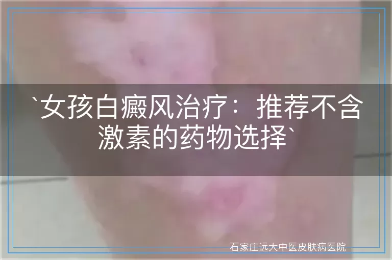 女孩白癜风治疗：推荐不含激素的药物选择