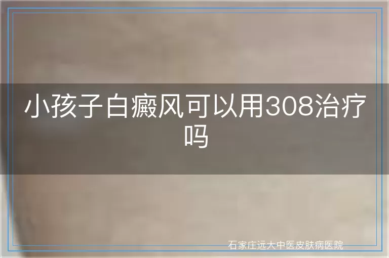 小孩子白癜风可以用308治疗吗