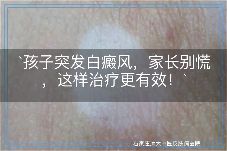 孩子突发白癜风，家长别慌，这样治疗更有效！
