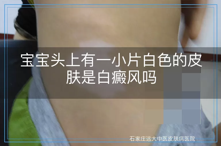 宝宝头上有一小片白色的皮肤是白癜风吗