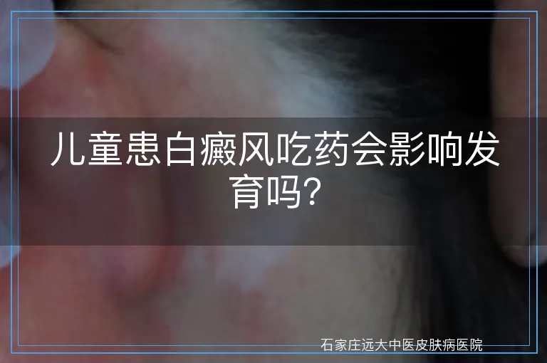 儿童患白癜风吃药会影响发育吗？