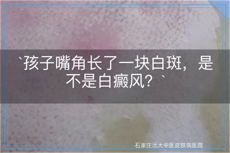 孩子嘴角长了一块白斑，是不是白癜风？