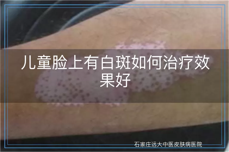 儿童脸上有白斑如何治疗效果好
