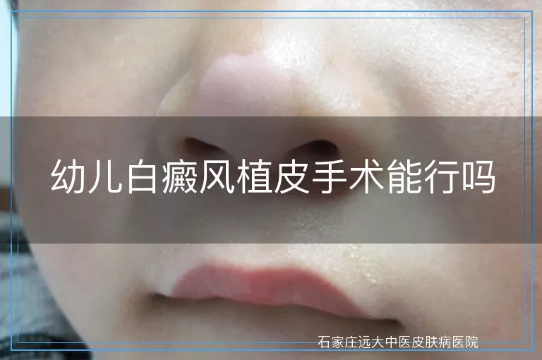 幼儿白癜风植皮手术能行吗