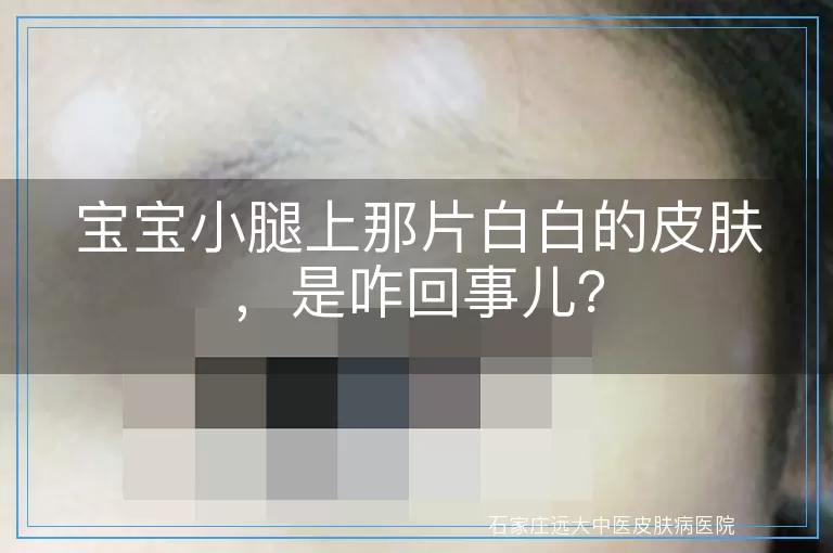 宝宝小腿上那片白白的皮肤，是咋回事儿？
