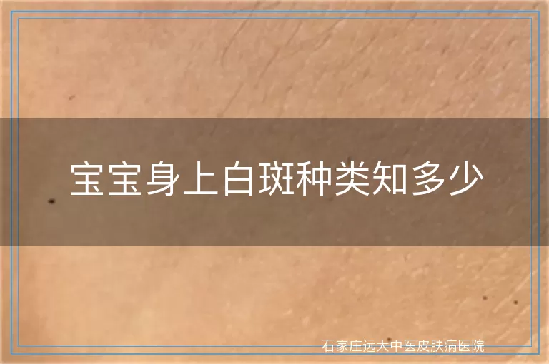宝宝身上白斑种类知多少