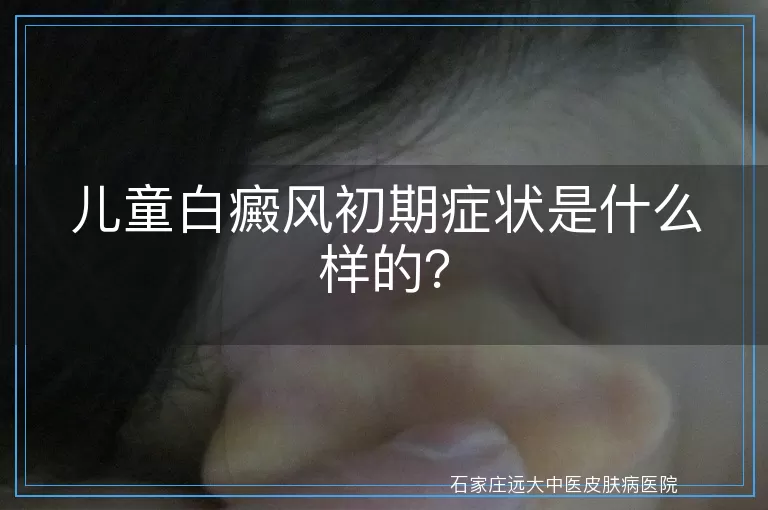 儿童白癜风初期症状是什么样的？
