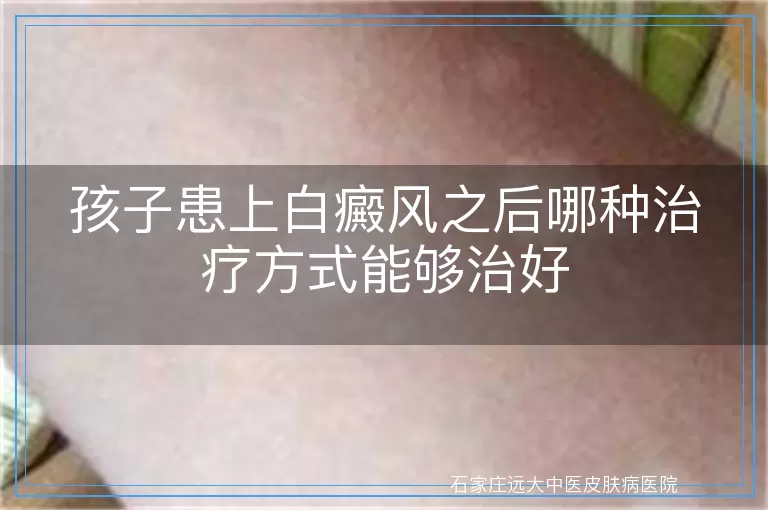 孩子患上白癜风之后哪种治疗方式能够治好
