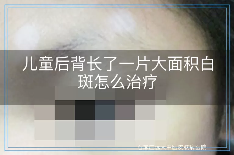 儿童后背长了一片大面积白斑怎么治疗