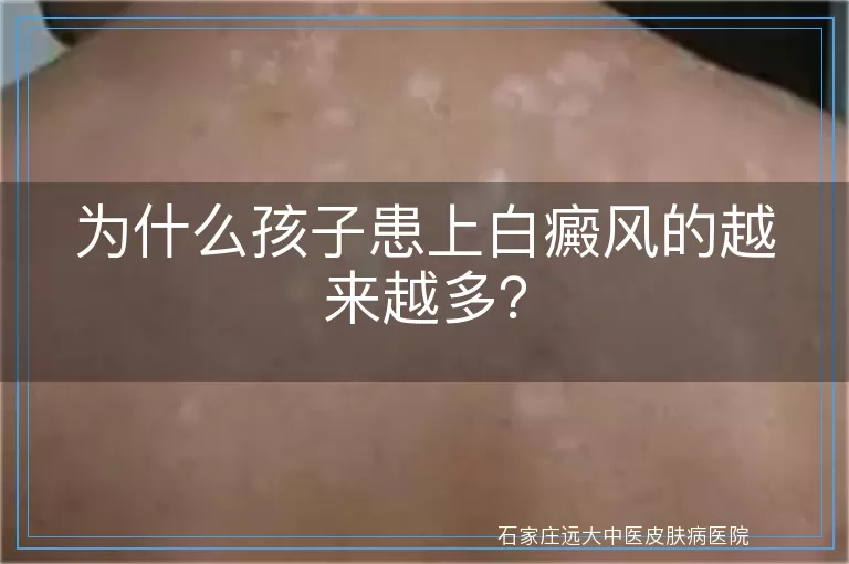 为什么孩子患上白癜风的越来越多？