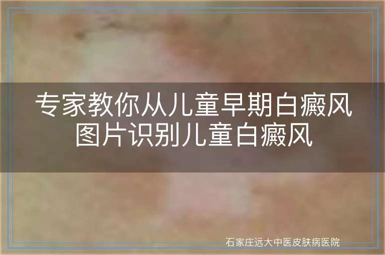 专家教你从儿童早期白癜风图片识别儿童白癜风