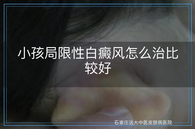 小孩局限性白癜风怎么治比较好