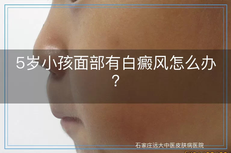 5岁小孩面部有白癜风怎么办？