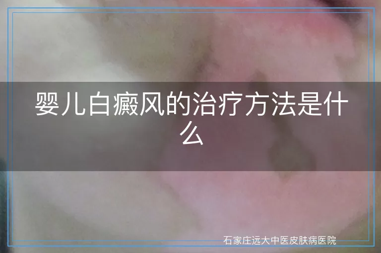 婴儿白癜风的治疗方法是什么