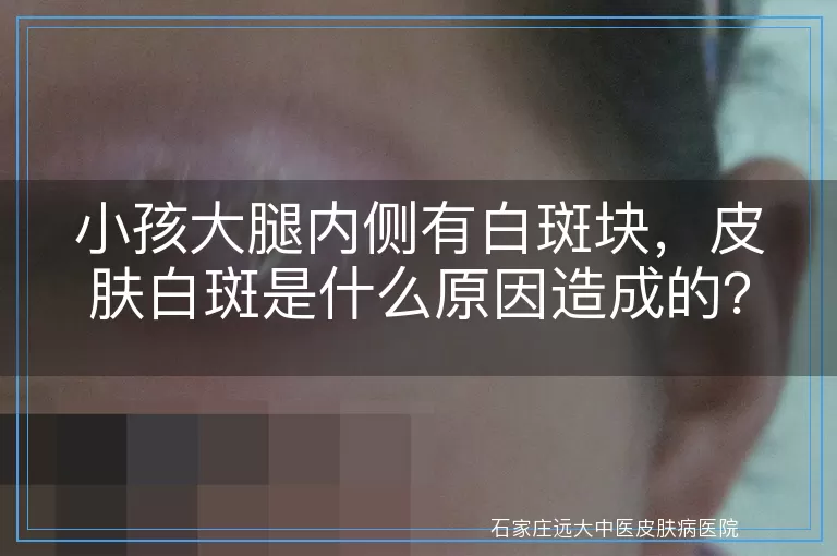 小孩大腿内侧有白斑块，皮肤白斑是什么原因造成的？