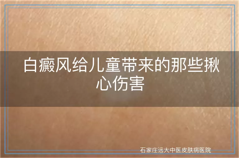 白癜风给儿童带来的那些揪心伤害