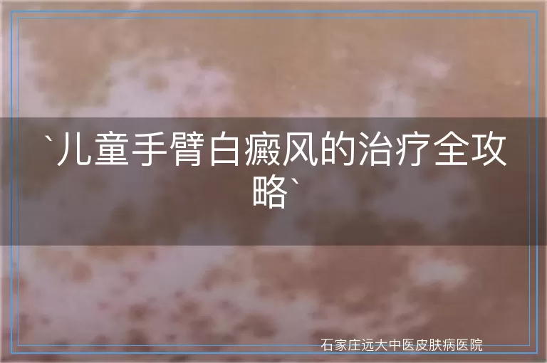 儿童手臂白癜风的治疗全攻略
