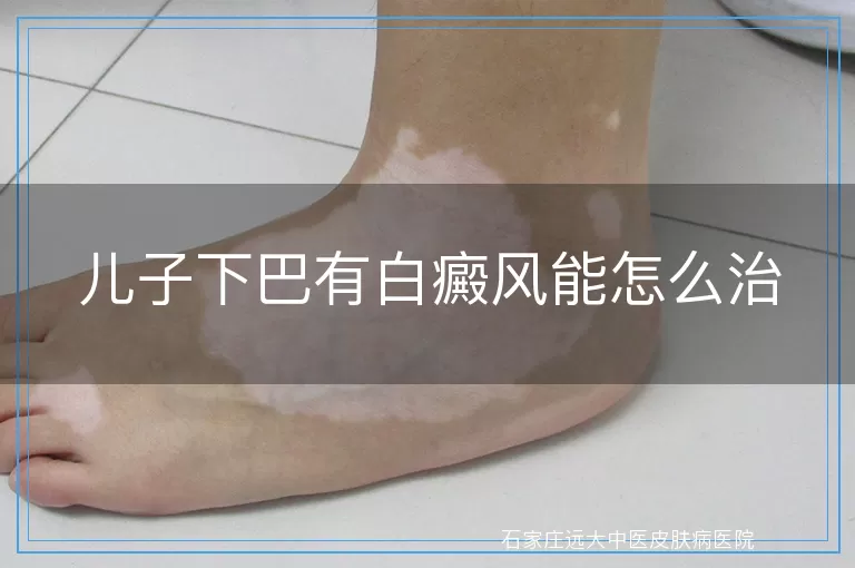 儿子下巴有白癜风能怎么治