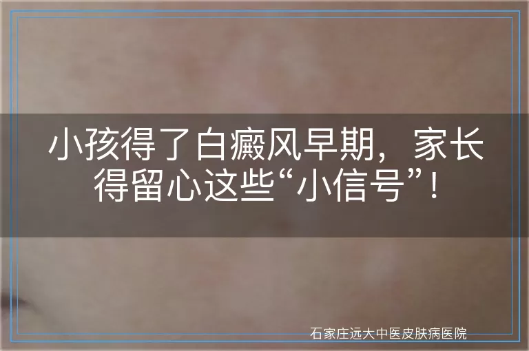 小孩得了白癜风早期，家长得留心这些“小信号”！