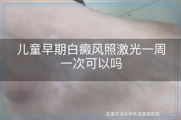 儿童早期白癜风照激光一周一次可以吗