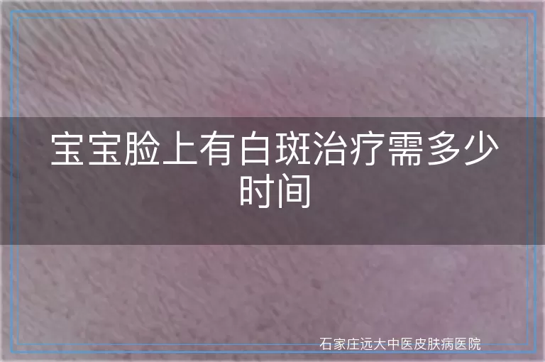 宝宝脸上有白斑治疗需多少时间