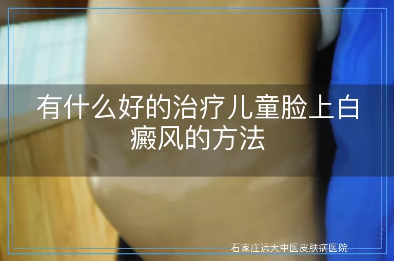 有什么好的治疗儿童脸上白癜风的方法