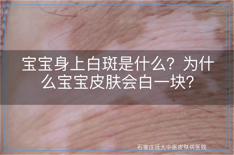宝宝身上白斑是什么？为什么宝宝皮肤会白一块？