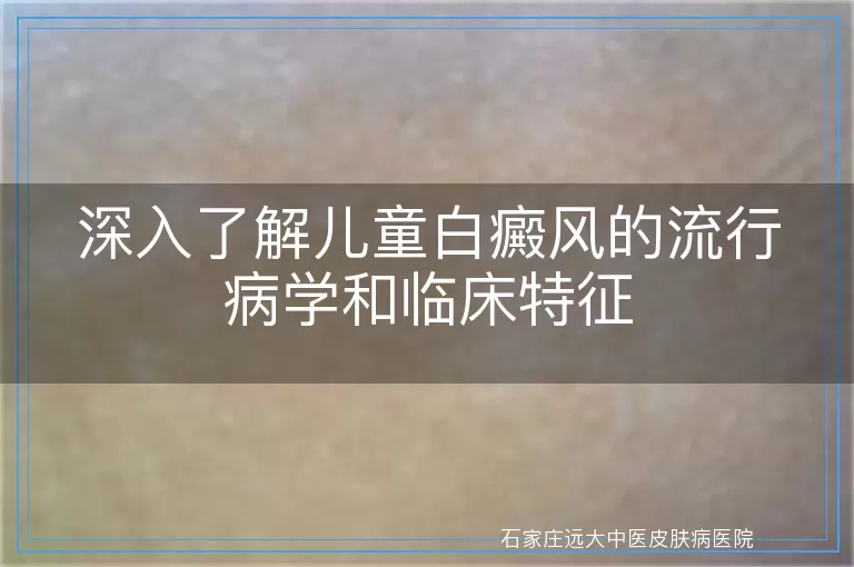 深入了解儿童白癜风的流行病学和临床特征