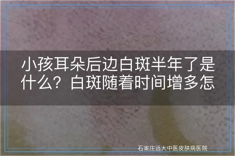 小孩耳朵后边白斑半年了是什么？白斑随着时间增多怎么办？