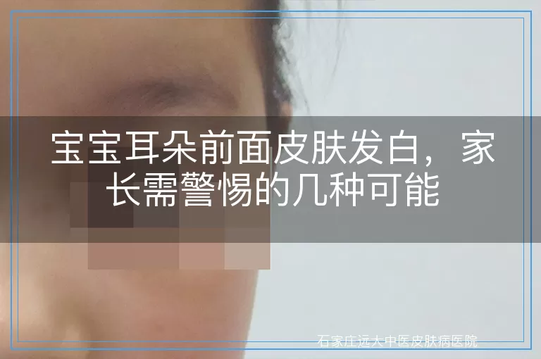 宝宝耳朵前面皮肤发白，家长需警惕的几种可能