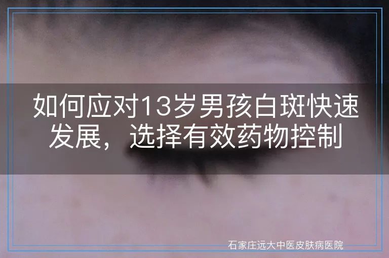 如何应对13岁男孩白斑快速发展，选择有效药物控制