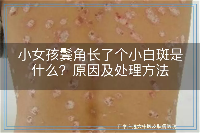 小女孩鬓角长了个小白斑是什么？原因及处理方法