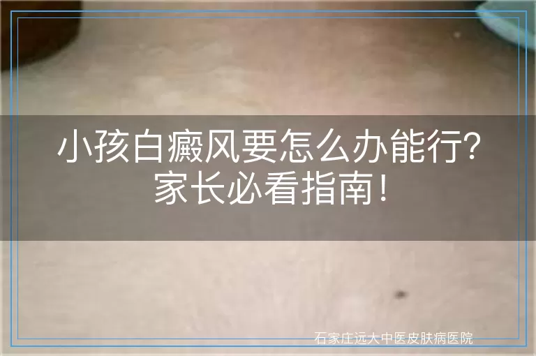 小孩白癜风要怎么办能行？家长必看指南！