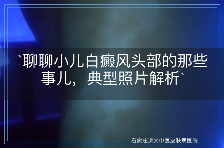 聊聊小儿白癜风头部的那些事儿，典型照片解析
