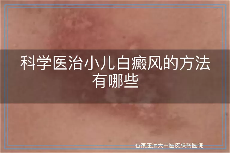 科学医治小儿白癜风的方法有哪些