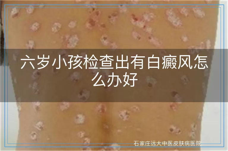 六岁小孩检查出有白癜风怎么办好