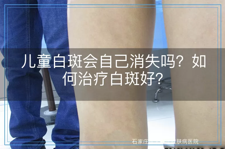 儿童白斑会自己消失吗？如何治疗白斑好？