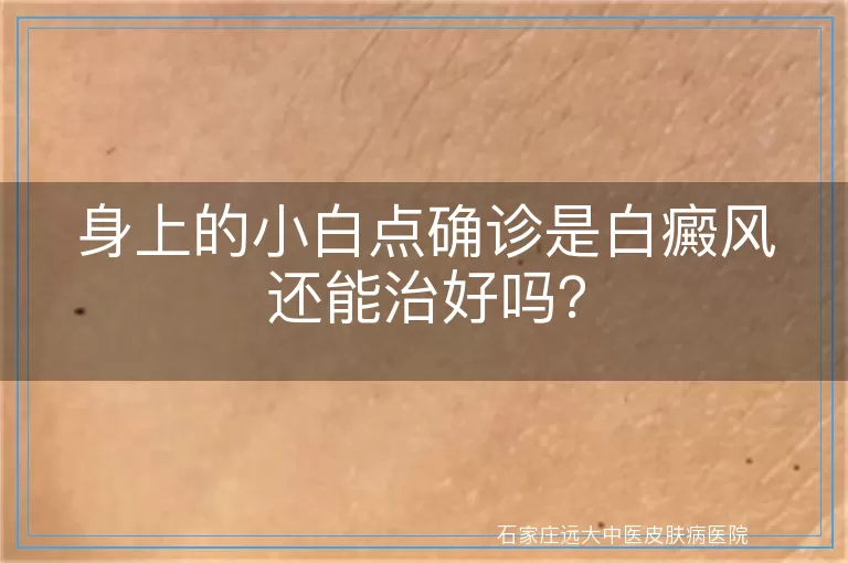身上的小白点确诊是白癜风还能治好吗？