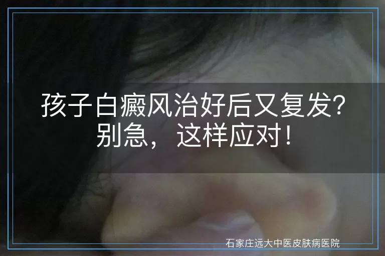 孩子白癜风治好后又复发？别急，这样应对！