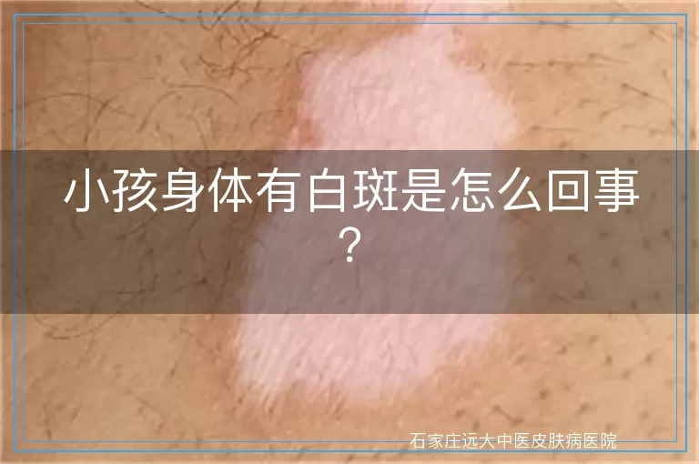 小孩身体有白斑是怎么回事?