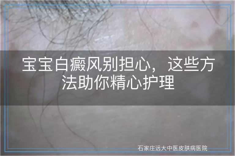 宝宝白癜风别担心，这些方法助你精心护理