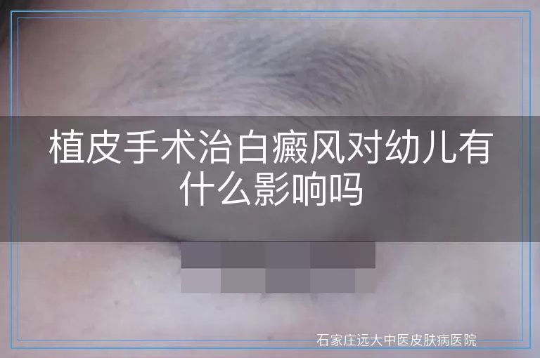 植皮手术治白癜风对幼儿有什么影响吗