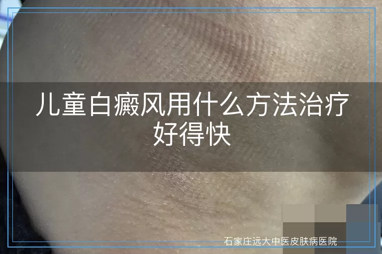 儿童白癜风用什么方法治疗好得快