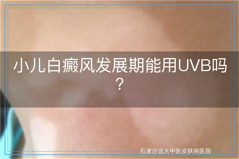 小儿白癜风发展期能用UVB吗？