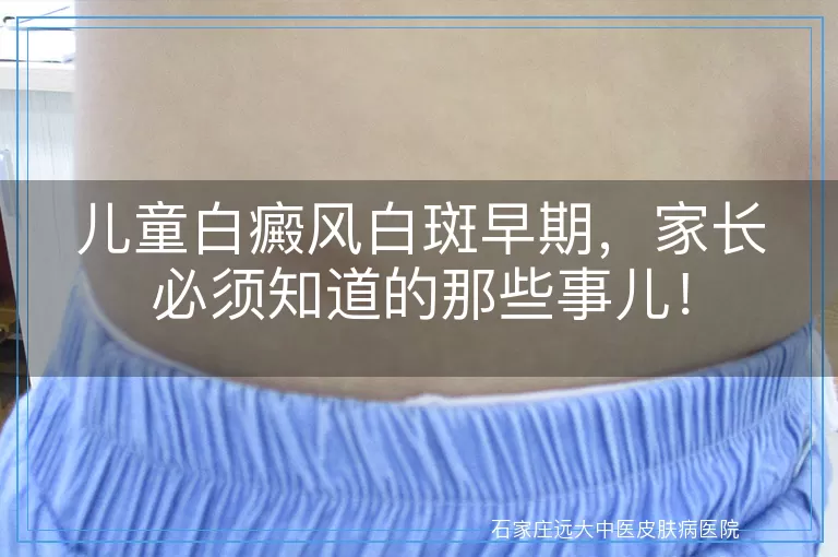 儿童白癜风白斑早期，家长必须知道的那些事儿！