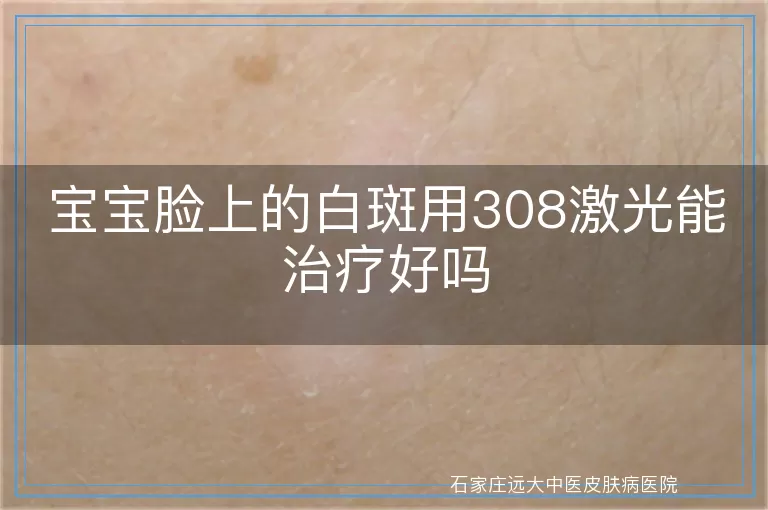 宝宝脸上的白斑用308激光能治疗好吗