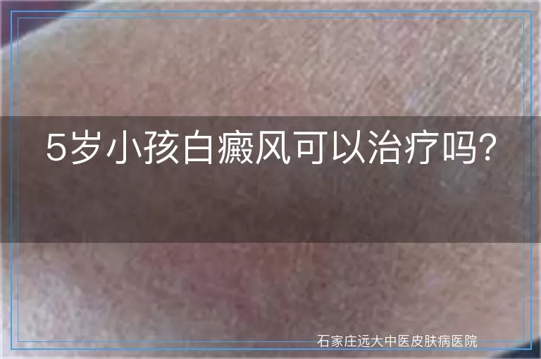 5岁小孩白癜风可以治疗吗？